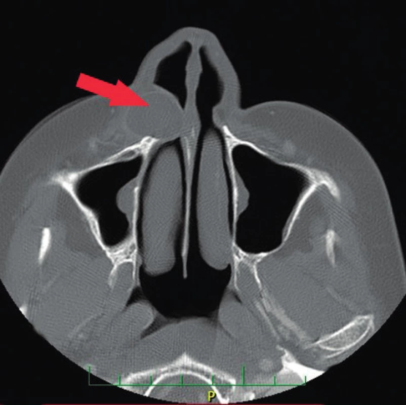 Oválné ostře ohraničené cystické ložisko před přední
stěnou maxily (šipka) vyklenující se do dutiny nosní, CT snímek,
axiální řez