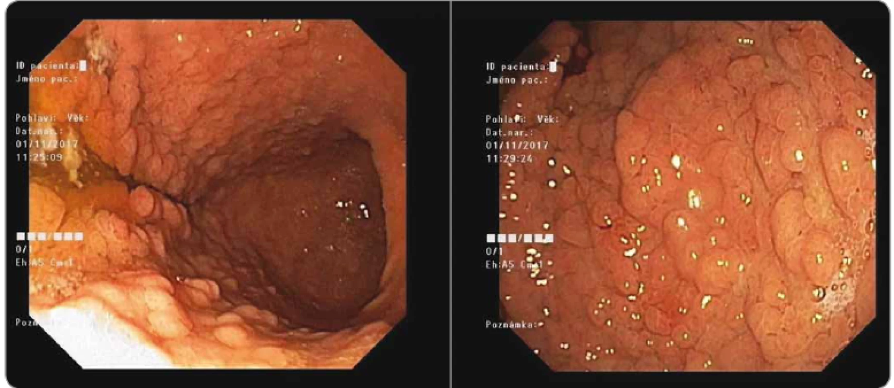 Gastroscopy with massive polyposis of stomach in gastric adenocarcinoma and proximal polyposis of the stomach patient
(Masaryk Memorial Cancer Institute).