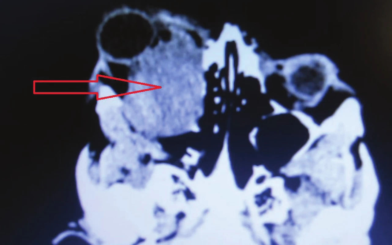 MRI findings with tumor masses arising from chiasm to the
orbit in 12/2015