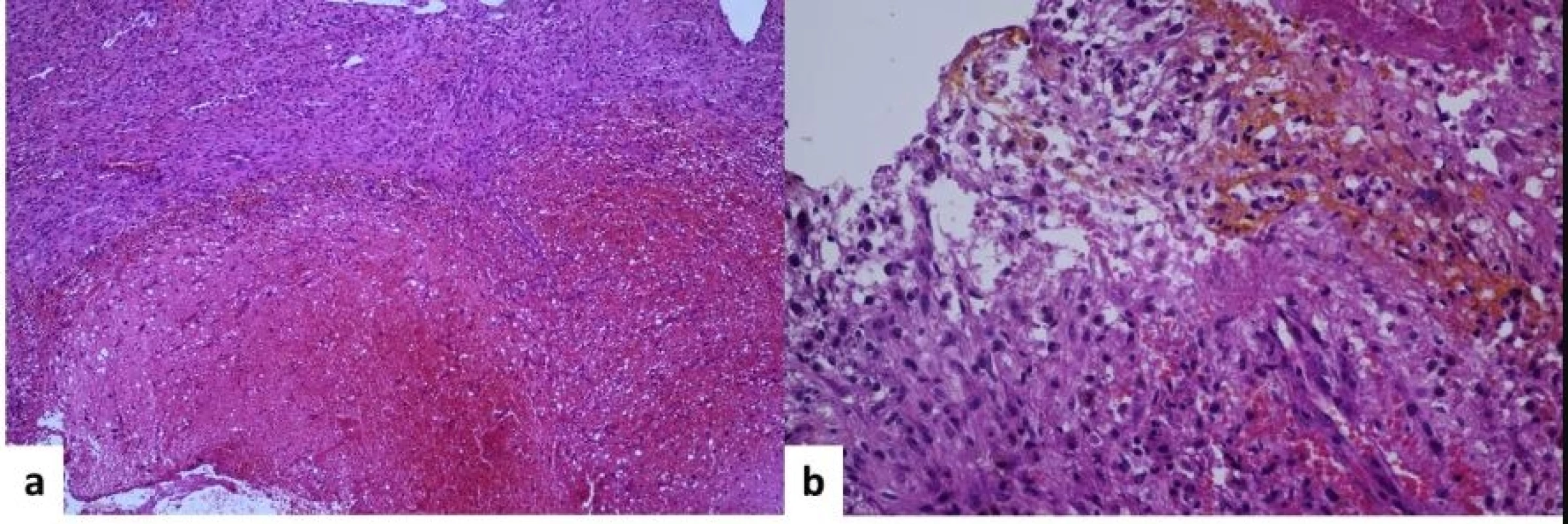 Histopathological exam. A – hematoxylin-eosin stain, 10×. Schwannoma with massive haemorrhage. B – hematoxylin-eosin stain, 40×. Antoni A schwannoma with hemosiderin-containing macrophages (siderophages).