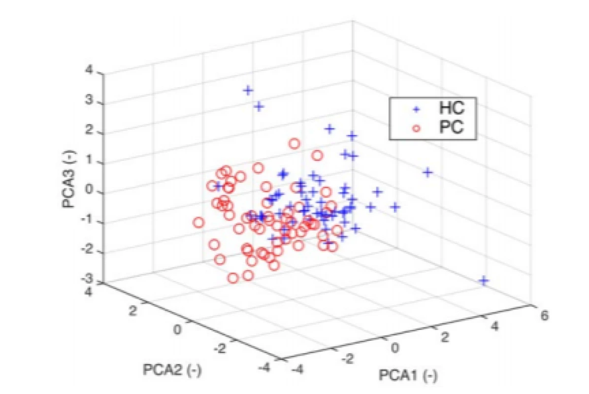  3D PCA space with visible clusters for HC and
PD. The 3D plot uses the first three principal
components which contain 80% of the original data
variability.