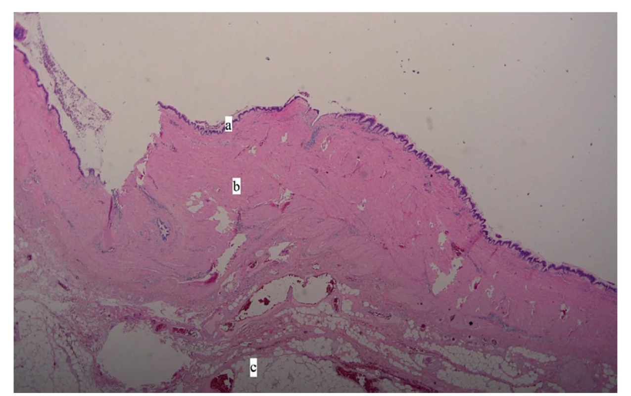 Histologický nález: a – epitel (cylindrický s řasinkami), b – stěna cysty, c – tuková tkáň
(Barvení H&E, zvětšeno 40x, autor: Z. Špůrková)<br>
Fig. 2: Histology image: a – epithelium (ciliated cylindrical), b – cyst wall, c – fat tissue
(H&E staining, 40x magnification, author: Z. Špůrková)