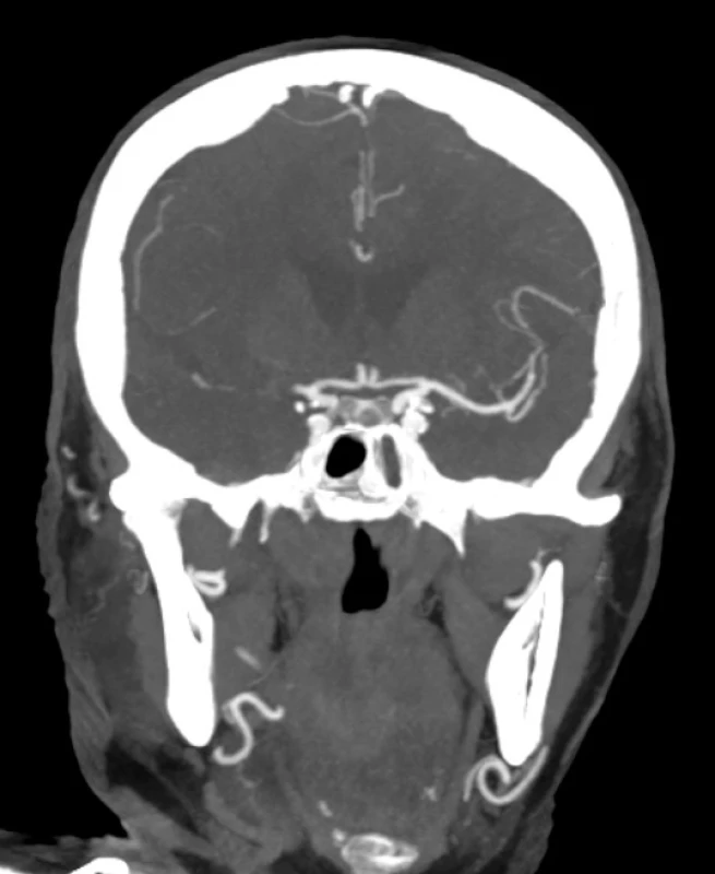 CT angiografie pacienta s akutním uzávěrem střední mozkové tepny vpravo
