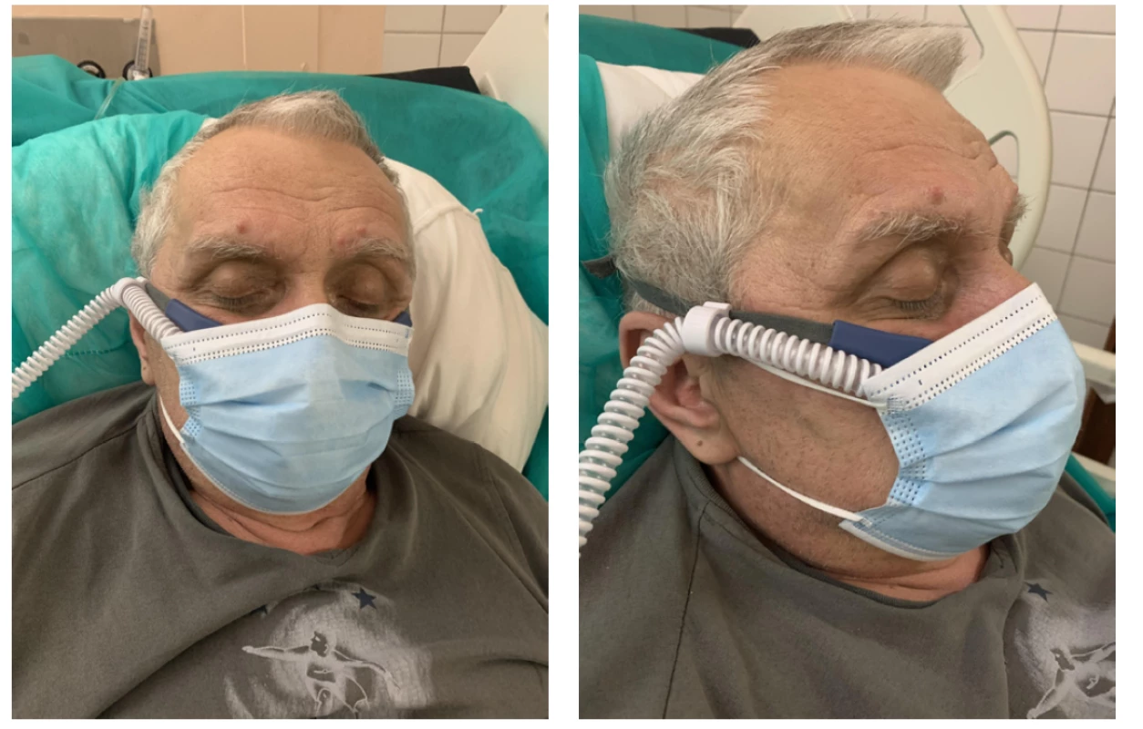 Pacient s HFNC a nasadeným chirurgickým rúškom počas testu. Chirurgické rúško prekrýva nos, ústa a bradu. Pacient leží v semi-Fowlerovej
polohe – hlavová časť postele je elevovaná 30 ° až 45 °