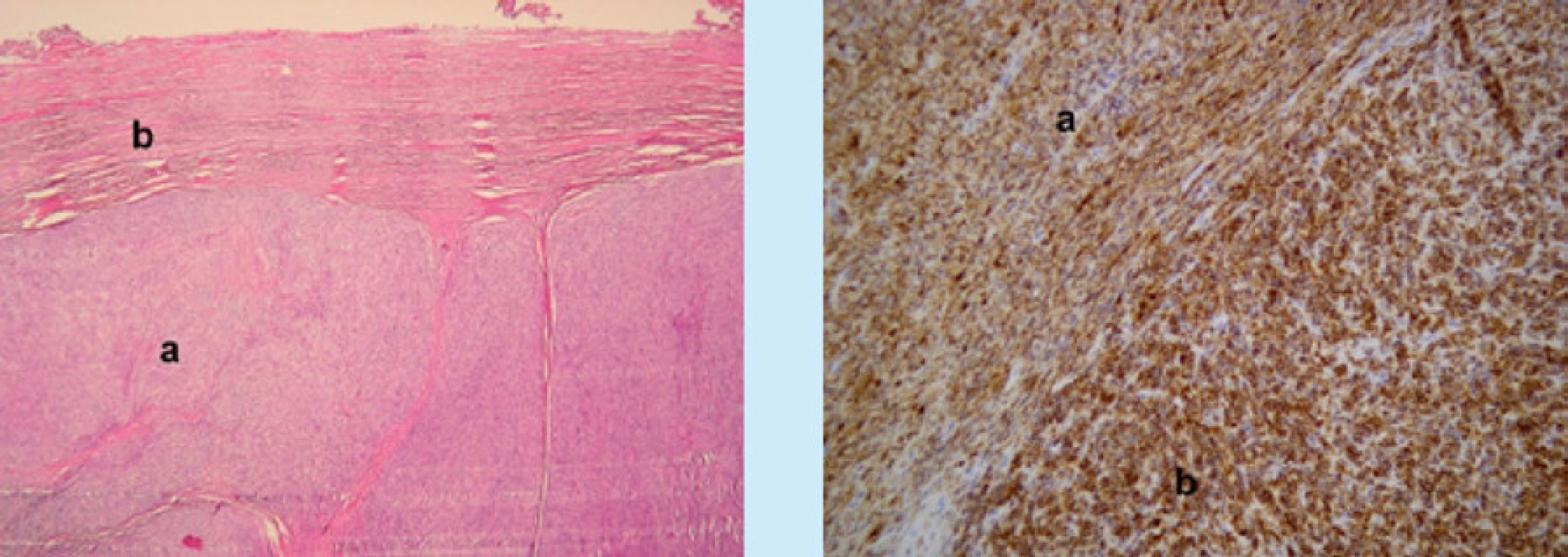 Mikroskopické obrazy STUMP s imunohistochemickým barvením. Vlevo (zvětšení 200×, Ki67) nízká proliferační
aktivita v dobře diferencovaných úsecích (a), jádra buněk v proliferační fázi mají hnědé zbarvení. V úsecích s odlišnou
morfologií je patrné zvýšení proliferační aktivity (b). Vpravo (zvětšení 200×, průkaz hladkosvalového aktinu, Smooth
Muscle Actin, SMA) dobře diferencované úseky nádorové tkáně tvořené vřetenitými buňkami jsou pozitivní, pozitivní
reakce je vizualizovaná hnědým zbarvením nádorových elementů (a), v nízce diferencovaných úsecích nádorového
ložiska tvořené buňkami s odlišnou morfologií je reakce negativní (b)<br>
Fig. 2. Microscopic images of STUMP with immunohistochemical staining. On the left (magnification 200 ×, Ki67)
low proliferative activity in well-differentiated sections (a), cell nuclei in the proliferation phase are brown in color. In
sections with different morphology, an increase in proliferative activity is evident (b). On the right (magnification 200 ×,
detection of smooth muscle actin, SMA) well-differentiated sections of tumor tissue formed by spindle cells are positive,
positive reaction is visualized by brown staining of tumor elements (a), in low-differentiated sections of tumor deposit
formed by cells with different morphology is a negative reaction (b)