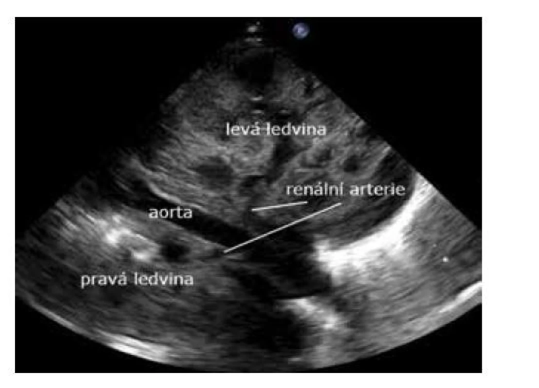 Zobrazení břišní aorty z retroperitonea
