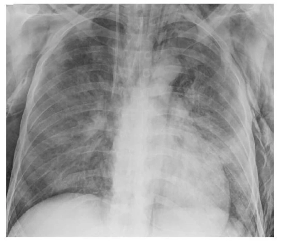 Skiagram hrudníku 16. 12. 2020 – oboustranné plicní infiltráty při
pneumonii způsobené covidem-19, komplikováno pravostranným pneumothoraxem
a rozsáhlým podkožním emfyzémem