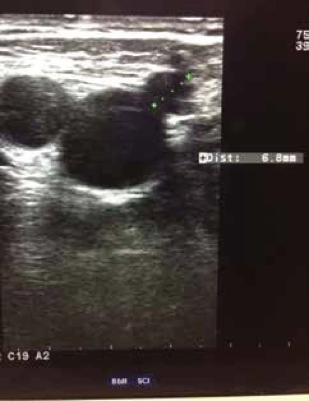 Dopplerovská ultrasonografie vena saphena magna