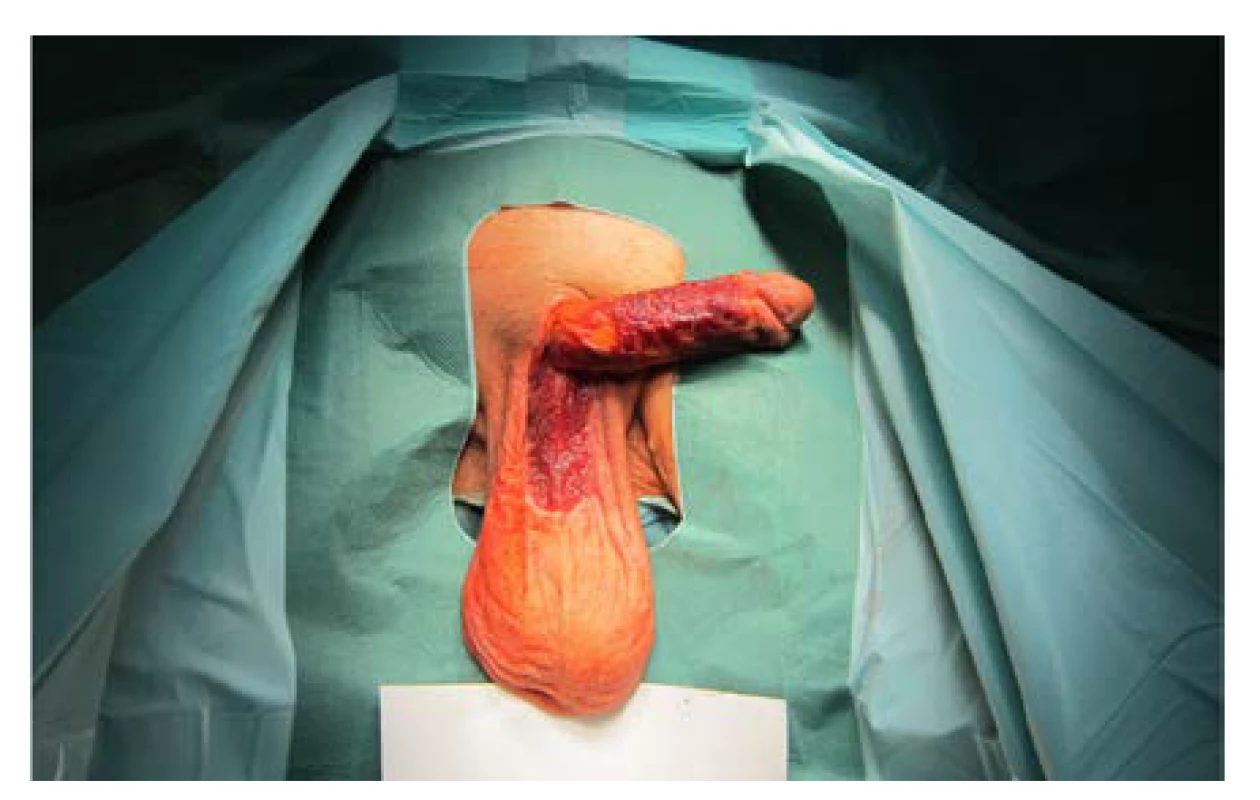 Granulační tkáň jeden měsíc po nekrektomii
kožního krytu penisu, předkožky i penoskrotální oblasti<br>
Fig. 4. Granulation tissue one month after necrectomy of
the penile skin, prepuce, and penoscrotal region