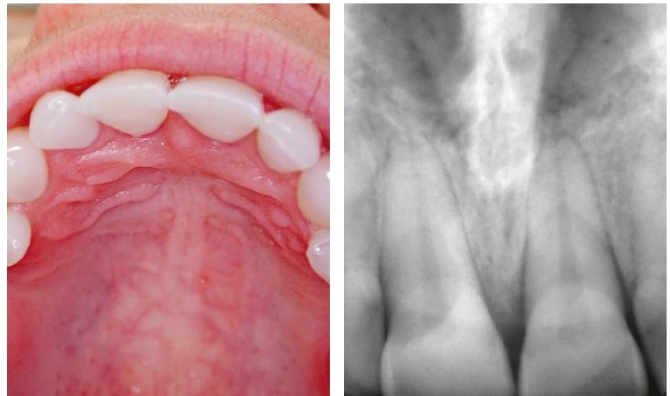a, b. Pohled na tvrdé patro po třech letech po ošetření se zhojeným slizničním defektem a zcela přirozeně vyhlížející gingivou ve viditelné části horního zubního oblouku (a) a kontrolní intraorální rentgenogram (radioviziografie) postiženého zubu v Cieszyńského projekci (b)