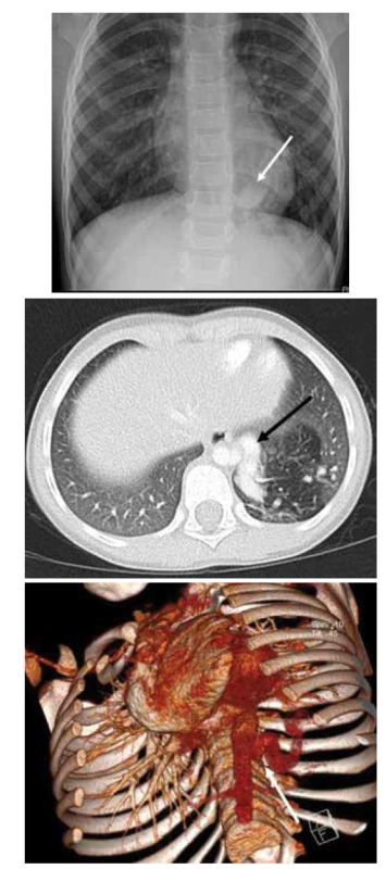 A. RTG plic, PS LDL, náhodný nález při kontrolním
snímku pro pravostrannou pneumonii.<br>
Fig. 6A. X-ray of the lungs, PS in left lower lobe, accidental
finding on control X-ray being done for the pneumonia in the
other side.<br>
Obr. 6B. CT plic, transverzální řez, PS LDL s mohutnou přívodnou
tepnou odstupující z hrudní aorty.<br>
Fig. 6B. CT of the lungs, transversal cut, PS in left lower lobe
with a huge artery supply from the thoracic aorta.<br>
Obr. 6C. CT plic, angiografie, 3D rekonstrukce.<br>
Fig. 6C. CT of the lungs, angiography, 3D reconstruction.