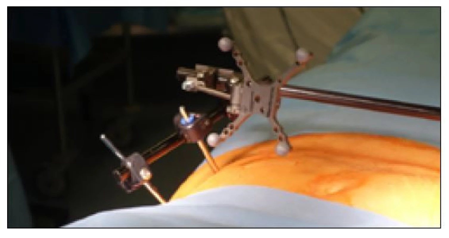 Navigační sonda fixována na tělo zevního fixátoru pánve pomocí
spinózního fixátoru