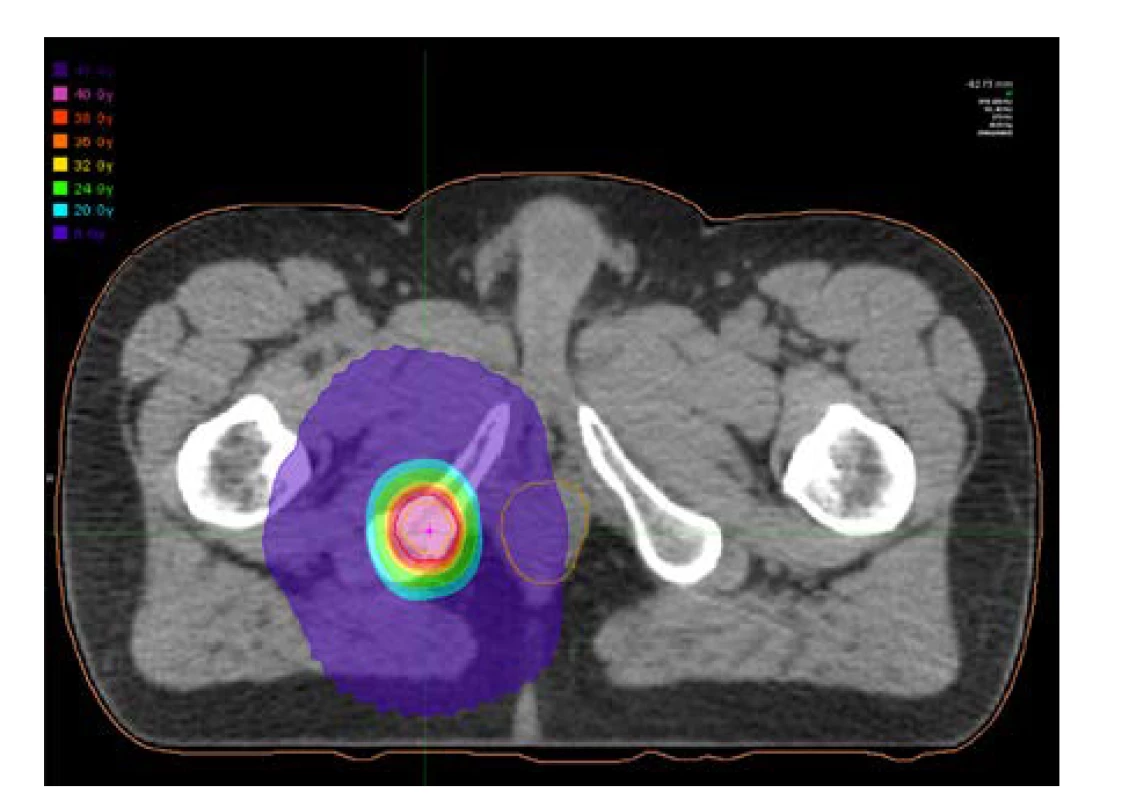 Plánovací CT s izodózami – solitární metastáza
v dolním raménku kosti stydké vpravo<br>
Fig. 2. Planning CT with isodoses – solitary metastasis
in the inferior ramus of the right pubic bone