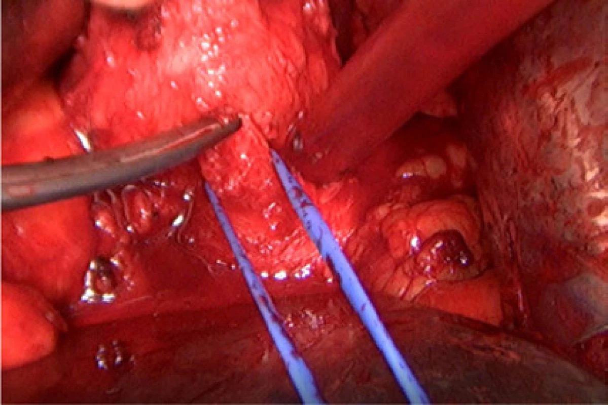Zahájení přerušení prostatické uretry na močovém katétru ostře nůžkami<br>
Fig. 4. Initiation of transection of the prostatic urethra
on a urinary catheter sharply with scissors 
