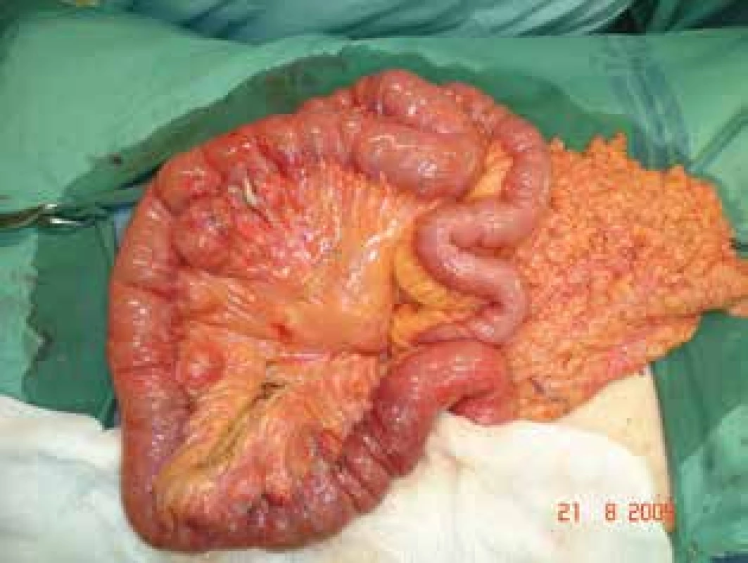 Tenké střevo s divertikly<br>
Fig. 1: Small bowel with diverticula