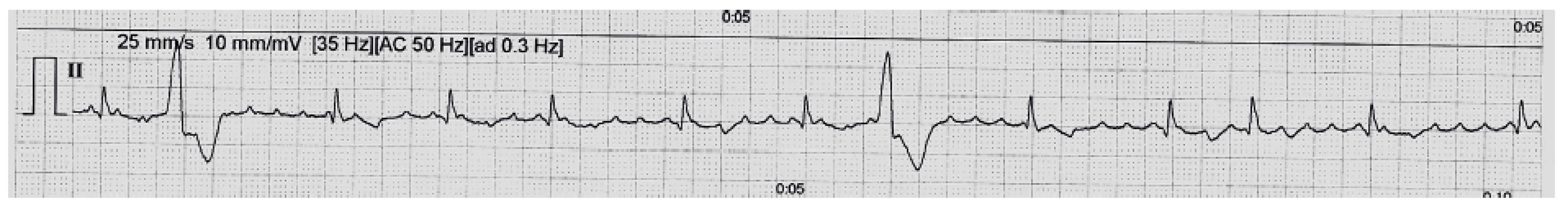 Záznam EKG z monitoru: Paroxysmus supraventrikulární tachykardie – popis je uveden v článku