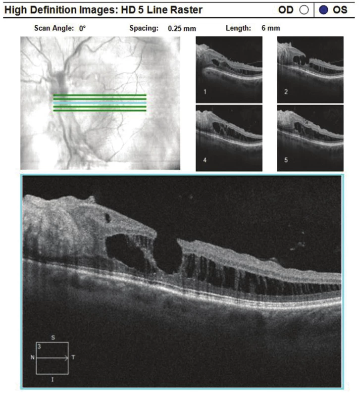 Optical coherence tomography of left eye: separation of layers of retina in lower temporal arcade with epiretinal fibrosis and defect of lamellar layers of retina