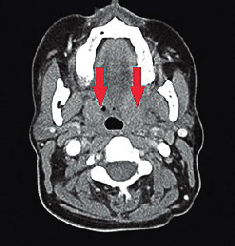CT nález u pacientky
č. 1, zachycující zduření v oblasti
patrových tonzil.