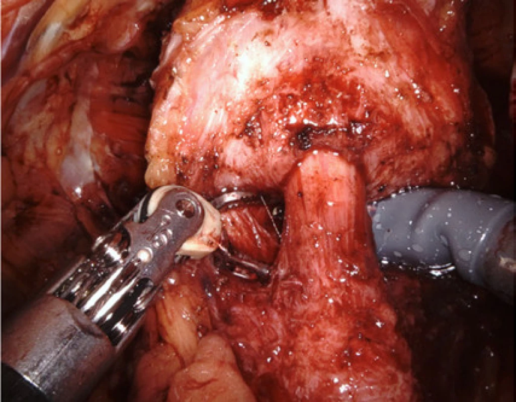 Detail kompletně uvolněného hrdla<br>
Fig. 3. Detail of the bladder neck having been separated
completely