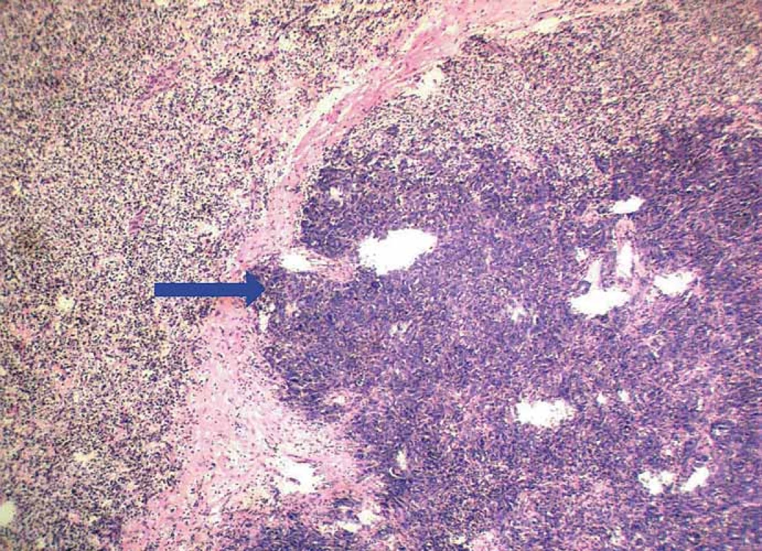 Conventional clear cell RCC (left and upper part) harboring a metastasis of adenocarcinoma
(blue arrow) (hematoxylin & eosin, magnification 100×).
