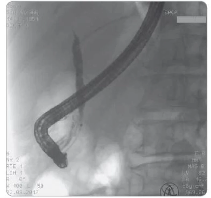 Obraz endoskopické retrográdní cholangiopankreatografi
e – možný typ III (suspektní stenotizace distální porce
ductus choledochus)