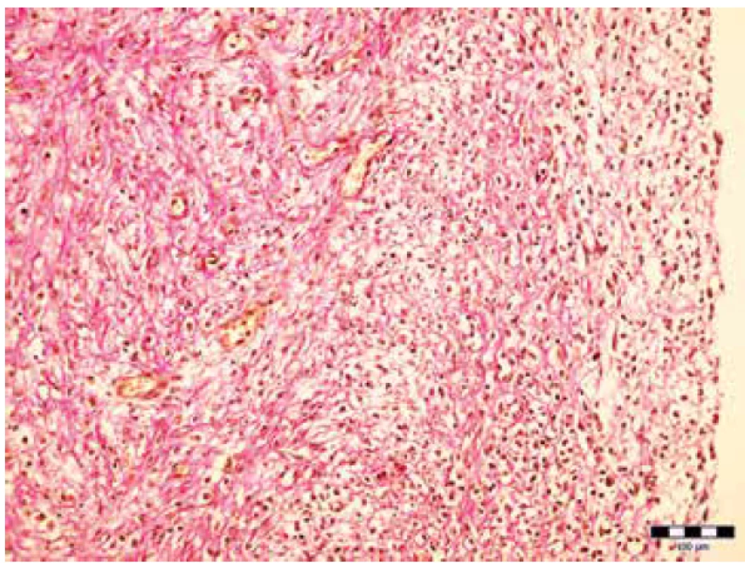 Periférna časť zhrubnutia s fibróznym tkanivom bohatým na fibroblasty.
Farbenie van Gieson (zväčšenie 200x).