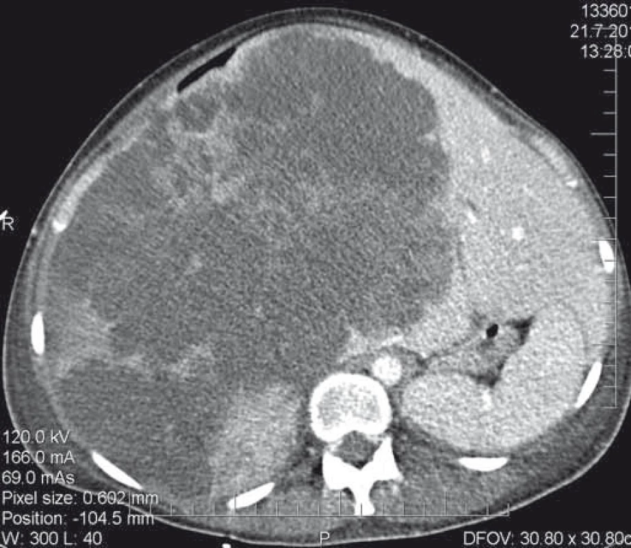 CT nález neoperabilního nálezu.<br>
Fig. 3. CT scan of an inoperable finding.