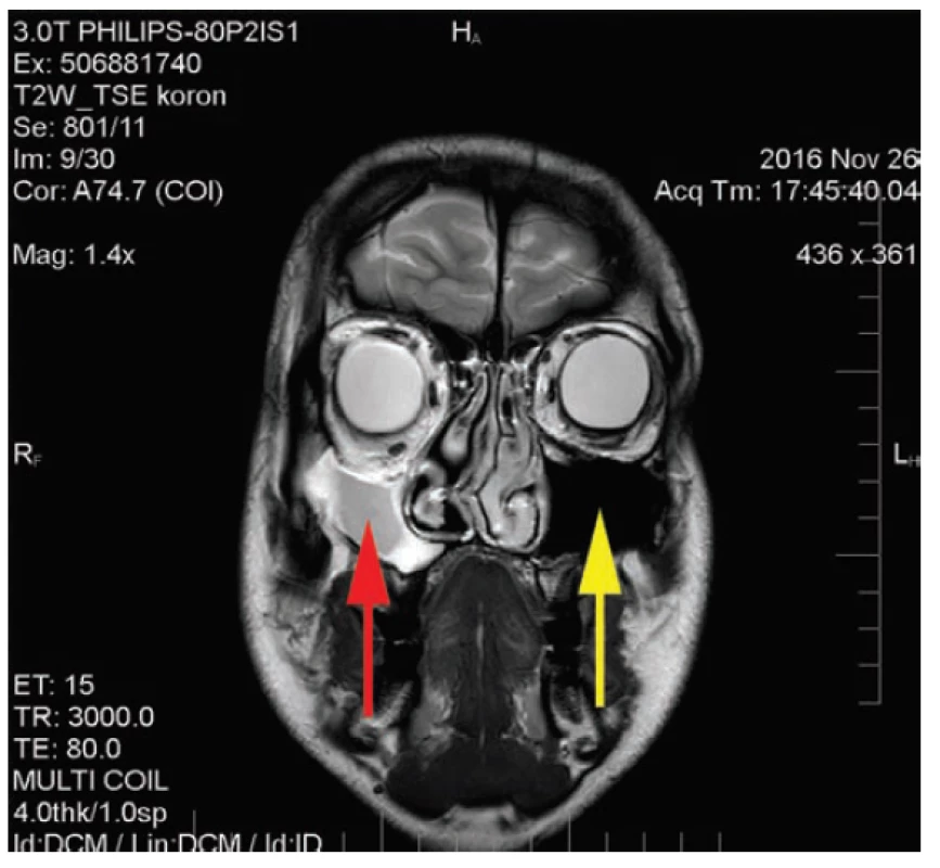 MR vyšetření: zmenšení a zastření pravého maxilárního
sinu, normální velikost i vzdušnost levého maxilárního sinu