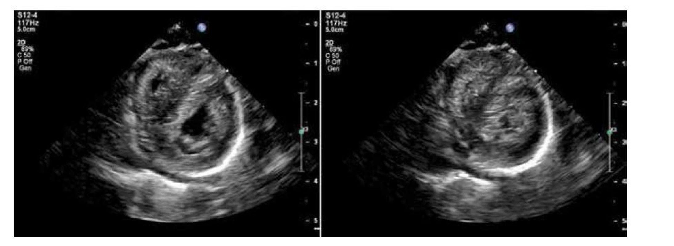 Echokardiografie, B obraz, projekce v krátké ose v diastole a systole (tentýž pacient jako na obr. 1)