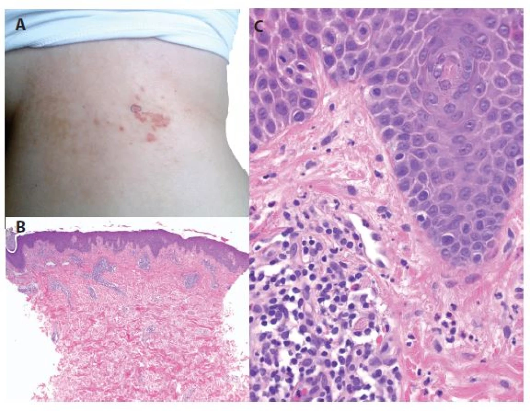 a, b, c. Prurigo pigmentosa<br>
a) bioptovaná makulopapula
na boku<br>
b) perivaskulární dermatitida
(HE 40x)<br>
c) v epidermis nevýrazná
spongióza, ojedinělá
lymfocytární exocytóza,
v koriu perivaskulární
lymfocytární
infiltráty s příměsí
neutrofilů se známkami
fragmentace jader
přítomných v lumen
cév a pronikajících do
papil, ojedinělé eozinofily
(HE 400x)