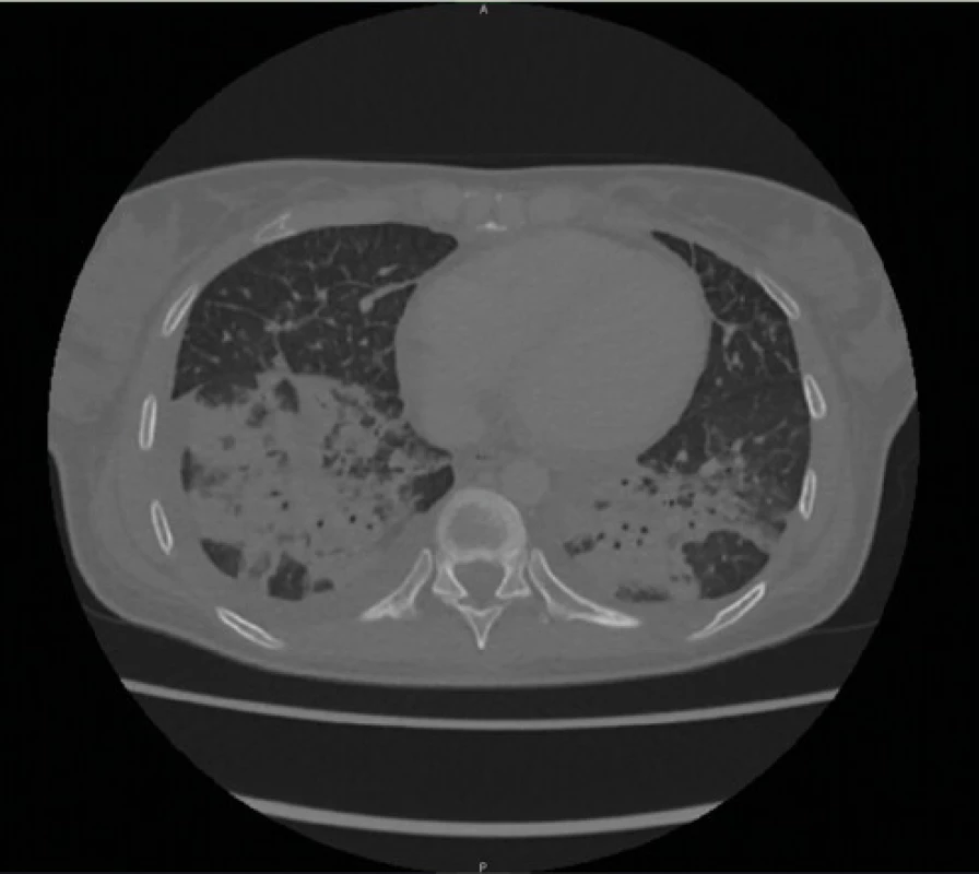 CT hrudníka – bilaterálna pleuropneumónia