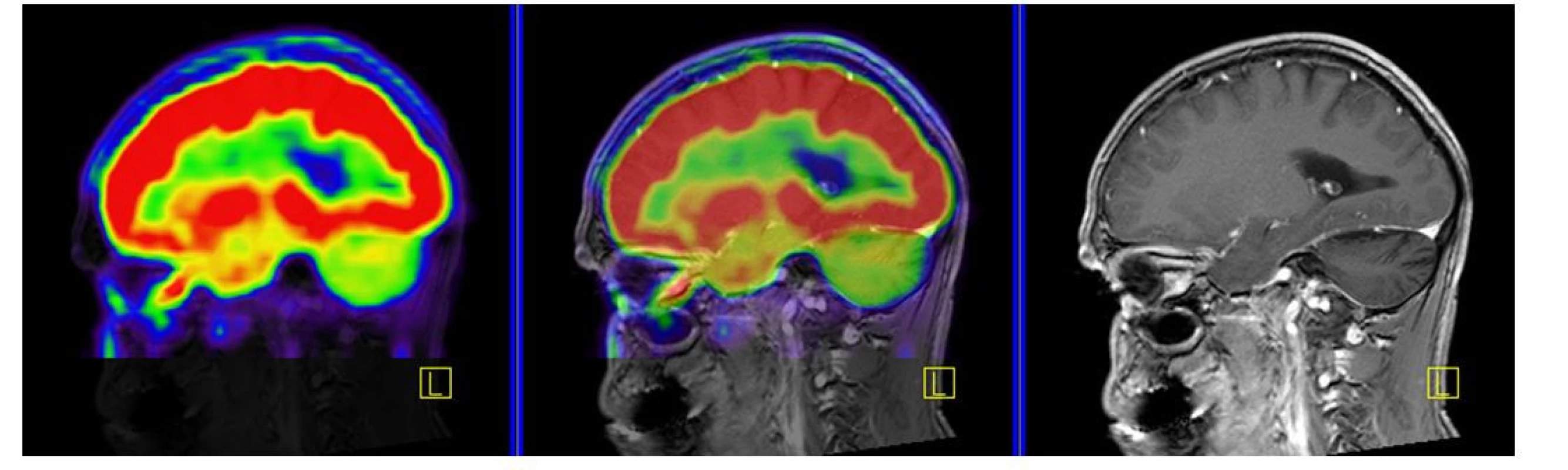 PET CT zobrazení mozku, červená barva znázorňuje intenzivní akumulaci fluorodeoxyglukózy (FDG), zatímco zelená barva odpovídá snížené
akumulaci FDG. V oblasti cerebella, které je postiženo neurodegenerativními změnami, je zřetelné výrazně snížené vychytávání FDG a neurodegenerativní
změny byly u tohoto pacienta zřetelné i na MR zobrazení