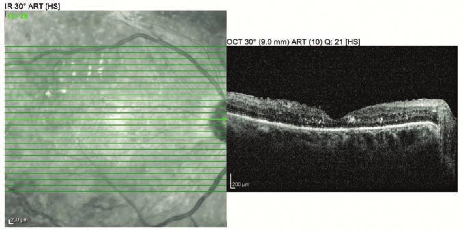 OCT vyšetření pravého oka 2 měsíce po operaci (5 měsíců po porodu)