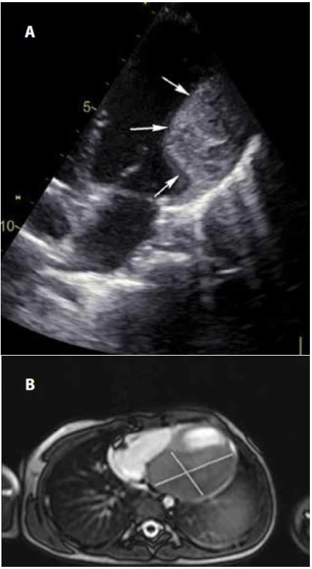 Fibrom postnatálně, echokardiografie (a) a magnetická
rezonance (b).<br>
Fig. 3. Postnatal fibroma, echocardiography (a), and magnetic
resonance imaging (b).