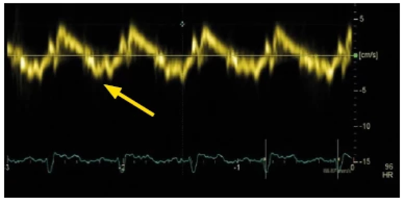 Tkáňově pulzní dopplerovský záznam pohybu septálního okraje
mitrálního anulu u nemocného s restriktivní kardiomyopatií. Významné
snížení rychlosti vlny e´(znázorněno šipkou)