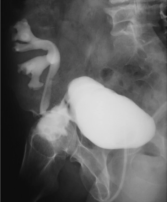 Cystografia. Únik moču z močového mechúra<br>
Fig. 8. Cystography. Urinary leak from the urinary
bladder