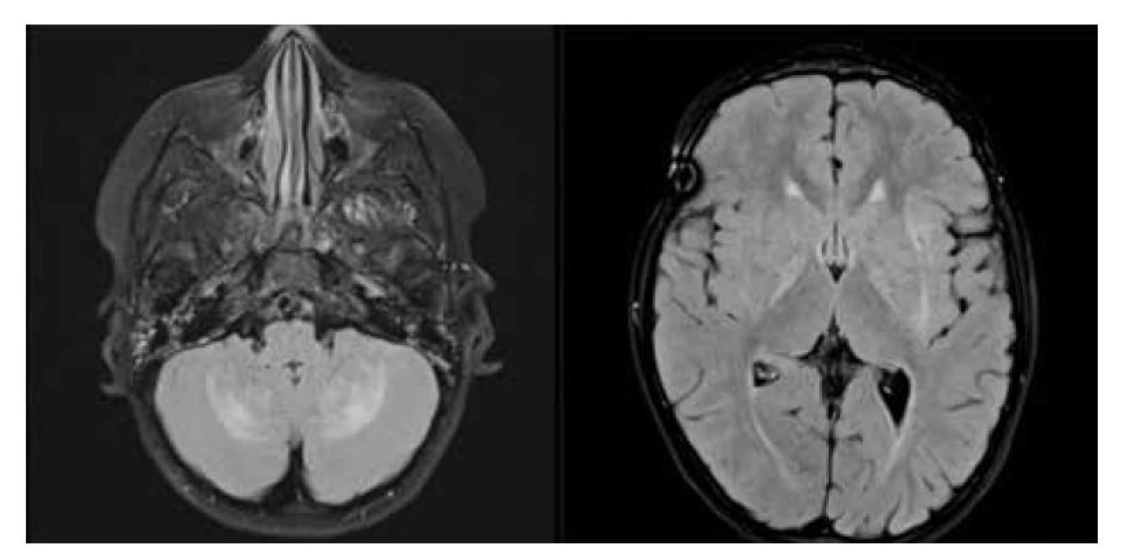 Neurodegenerace při LCH: a) MR scan – FLAIR sekevence v axiální rovině, hyperintenzní
léze mozečkových hemisfér a nuclei caudati bilat., b) MR scan – FLAIR sekevence
v axiální rovině, hyperintezní léze v bazálních gangliích oboustranně.<br>
Fig. 6. LCH neurodegeneration: a) MR FLAIR scan in axial plane, bilateral symmetric parenchymal
lesions of the cerebellum in the dentate nuclei, b) MR FLAIR scan in axial plane, bilateral
hyperintense lesions of the basal ganglia.