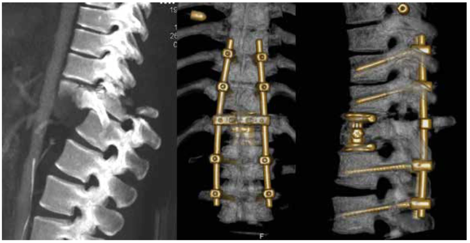 Dislokovaná zlomenina typu C s kompletní míšní lézi (N4) TL AOSIS – 12, řešená kombinovanou
dlouhou instrumentací<br>
Fig. 4. C type fracture with dislocation and complete spinal cord leasion (N4) TL AOSIS – 12, treated by
long combined instrumentation