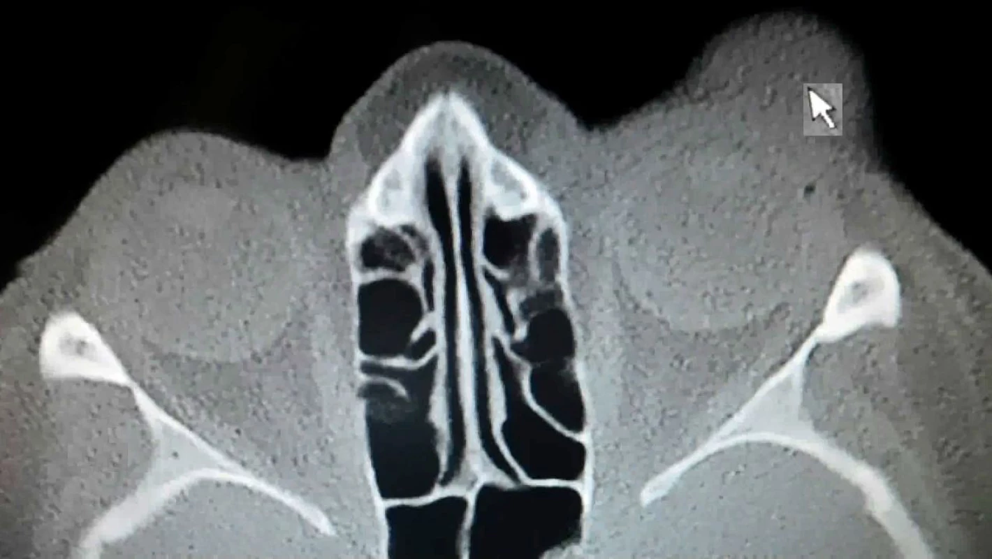 CT scan Patient 2 – arrow shows the lesion of MCC