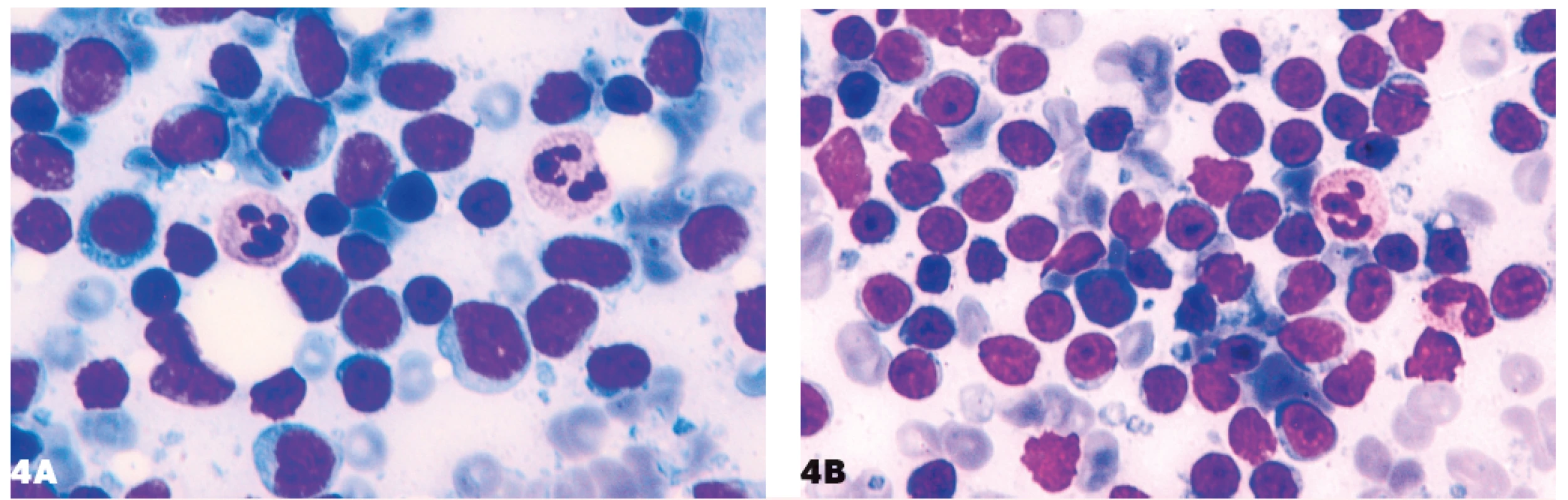 Podobnosť lymfocytov malobunkového lymfómu a lymfocytov pri nešpecifickej lymfadenitíde<br>
4A – folikulový lymfóm, 4B – nešpecifická lymfadenitída.