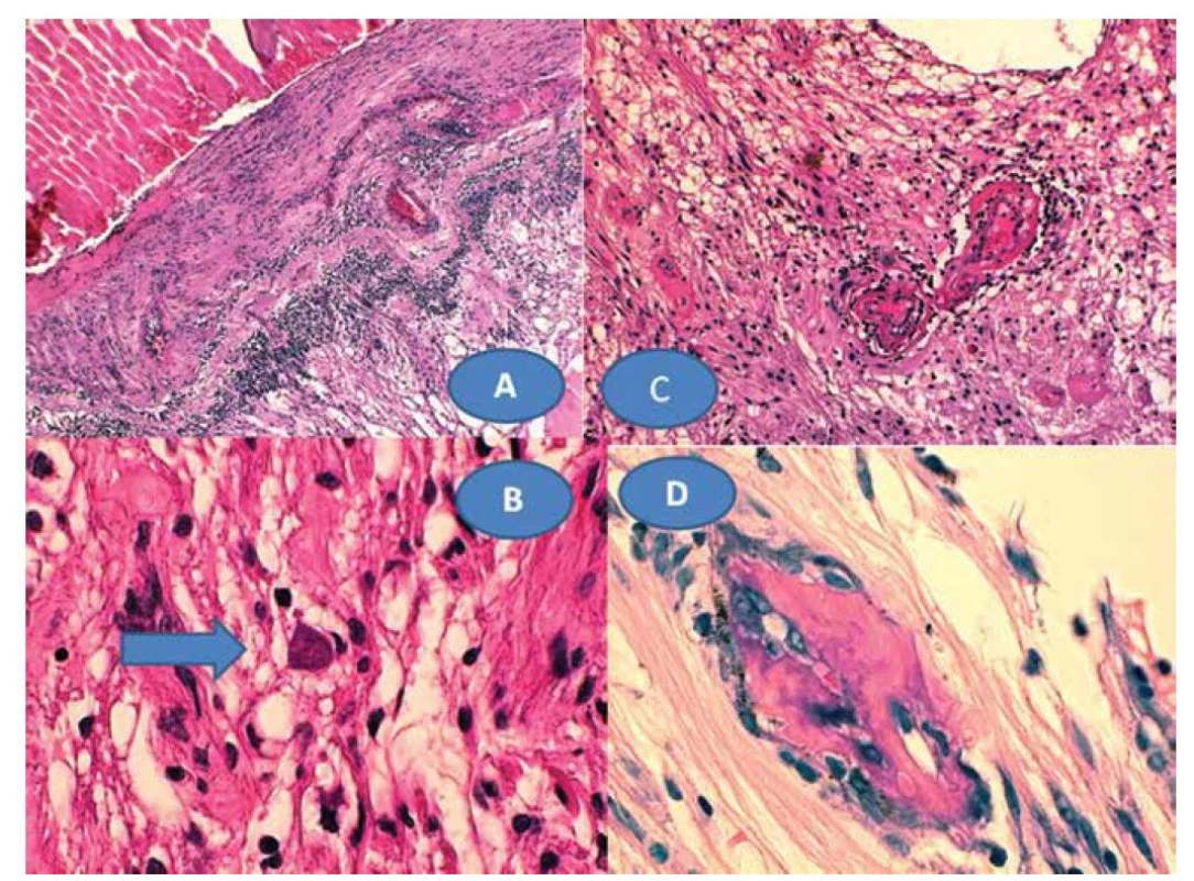 Chronická retinochoroiditida (A) zvětšení 50x, HE. Toxoplazmová cysta s bradyzoity – šipka (B), zvětšení 500x, HE.
Vaskulitida sítnice s trombózami (C), zvětšení 125x, HE. Mikrokalcifikace zachycené v granulomech (D), zvětšení 500x, HE