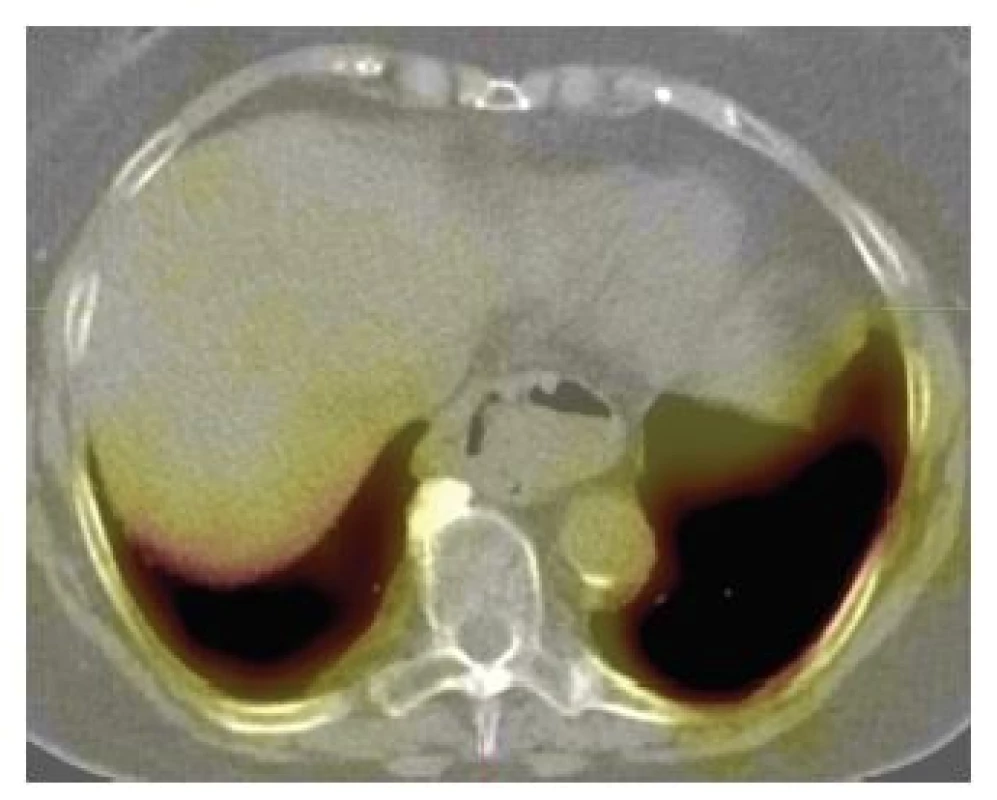 LDCT obraz transverzálního řezu hrudníkem v úrovni Th 11. Je
patrná část žaludku s bublinou vsunutá do hrudní dutiny vpravo před
aortou, tentokrát bez akumulace radiofarmaka.