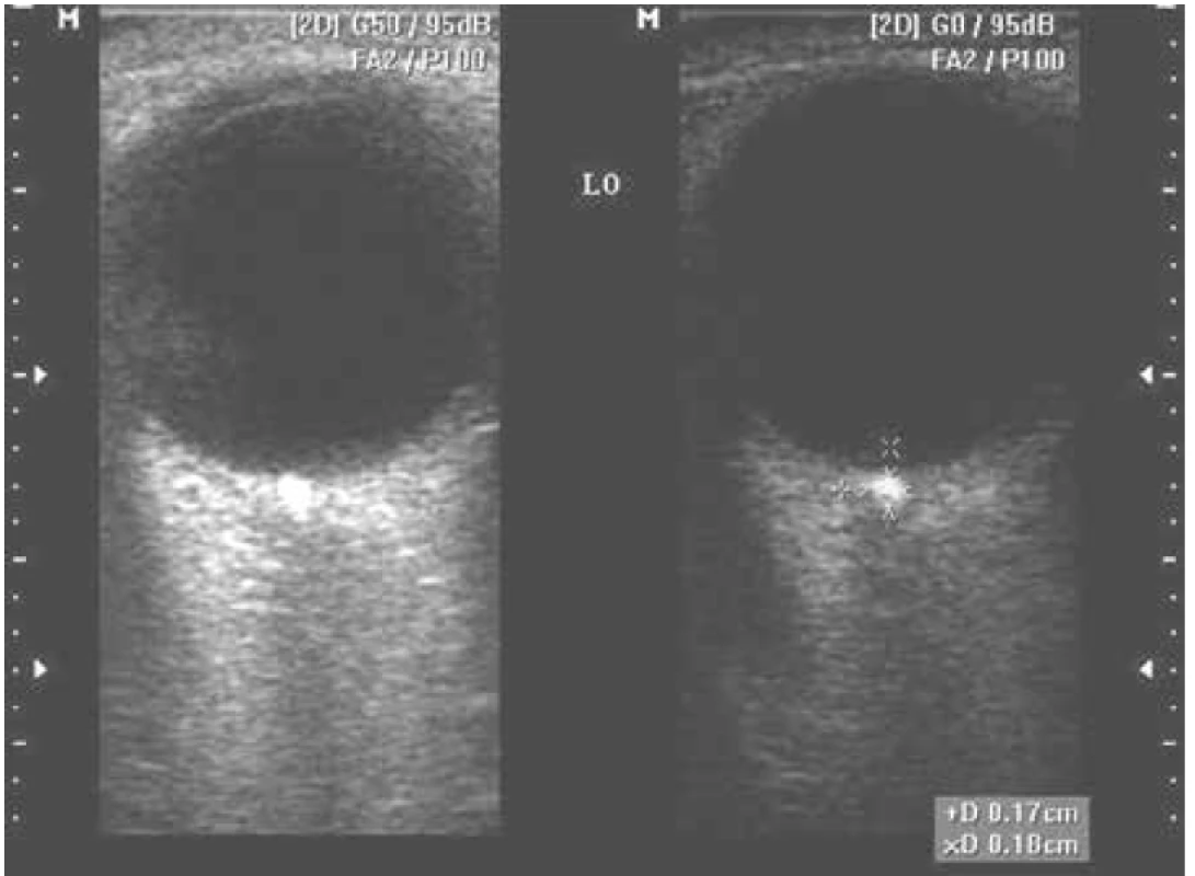 USG zobrazenie B-scan drúz terča optického nervu - III skupina
(podľa veľkosti)