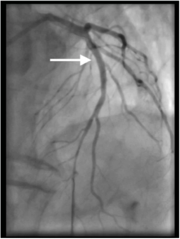 Koronarografický obraz po primární angioplastice s implantací lékového stentu 