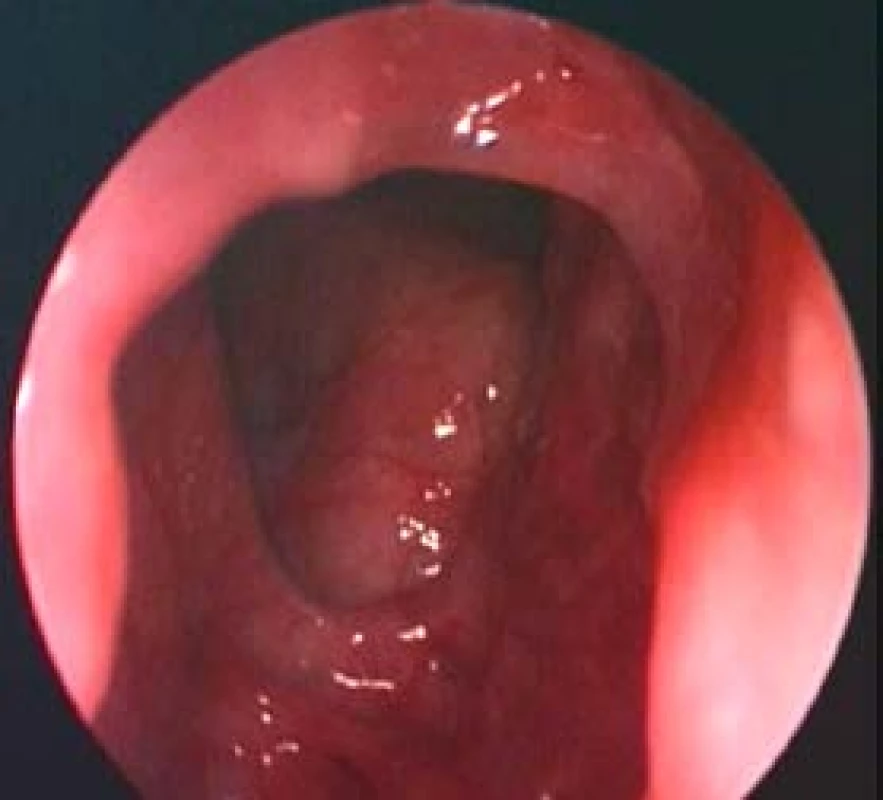 Pacient č. 1: Kontrolní pooperační endoskopické vyšetření – pohled do frontální dutiny vlevo