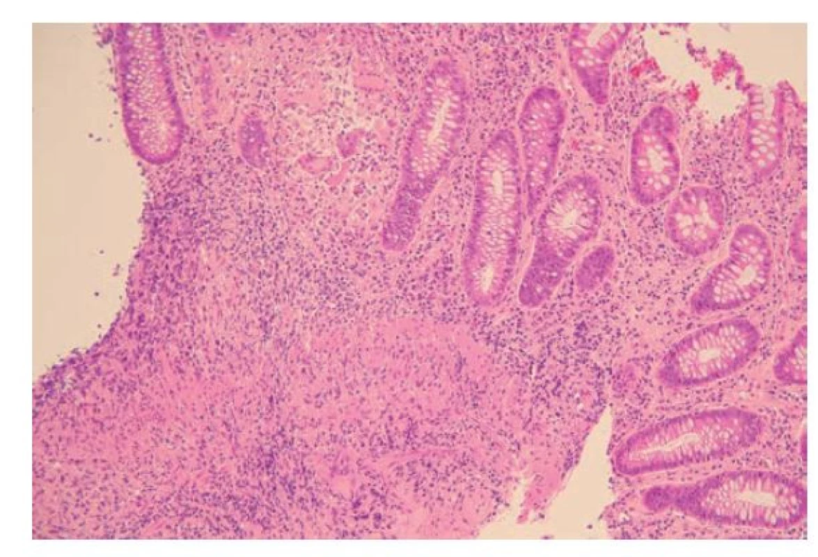 Bioptický odběr kolické sliznice u pacienta s Crohnovou chorobou.
V lamina propria je chronický zánět, který prostupuje do submukózy a je doprovázený
fibrotizací. Na více místech v lamina propria i v submukóze jsou
zastiženy vágně formované epiteloidní granulomy s přítomností mnohojaderných
buněk (hematoxylin a eosin, 200x).