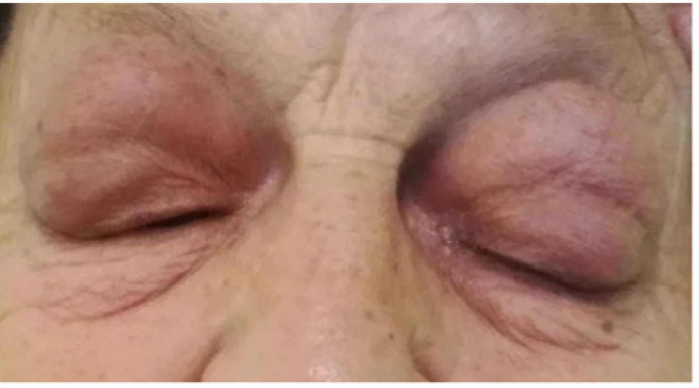 Patient 1 – bilateral, hyperemic tumours of the
upper eyelids