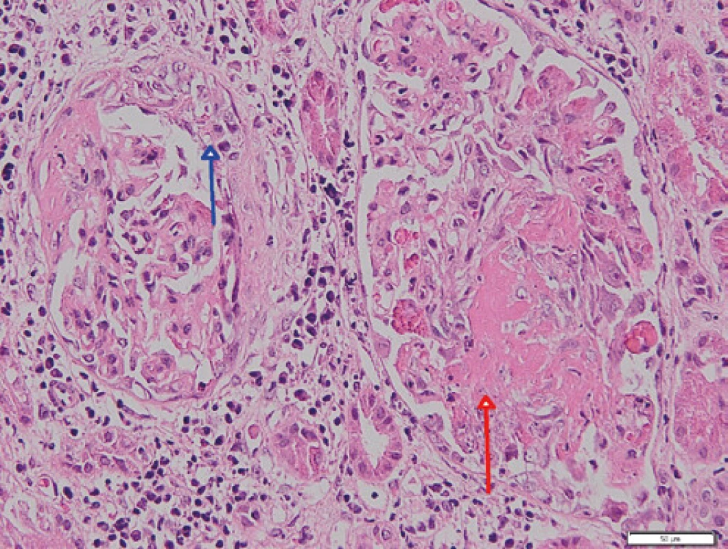 Glomeruly se segmentální nekrózou (červená šipka) a s celulárním 
srpkem (modrá šipka); barvení HE