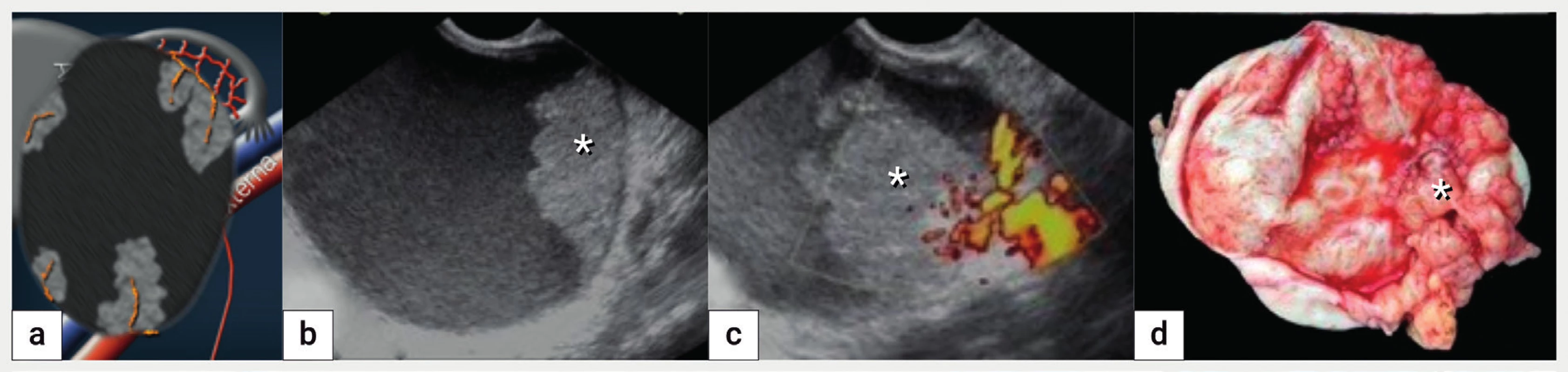 Maligní transformace endometroidní cysty<br>
Schéma unilokulární-solidní cysty s tekutinou vzhledu mléčného skla a vícečetnými solidními papilárními prominencemi s bohatou perfuzí (a),
ultrazvukové zobrazení v B-obraze (b), dopplerovské zobrazení perfuze uvnitř solidní papilární intracystické prominence (c), intraoperační nález
malignizace endometroidní cysty (podle histologie endometroidní adenokarcinom). Papilární intracystická prominence je označena hvězdičkou.