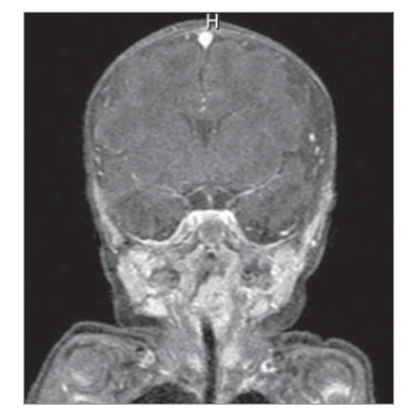 MR obraz, T1 vážený. Na
snímku patrný sytící se útvar obturující
vchod do laryngu.<br>
Fig. 1. MR image, T1 weighted. The
picture shows a saturating formation
obscuring the entrance to the larynx.